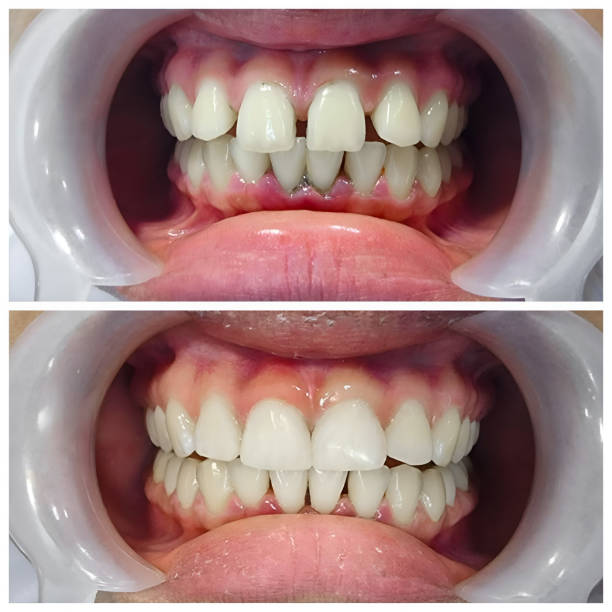 Full Mouth Reconstruction in Perry, OH